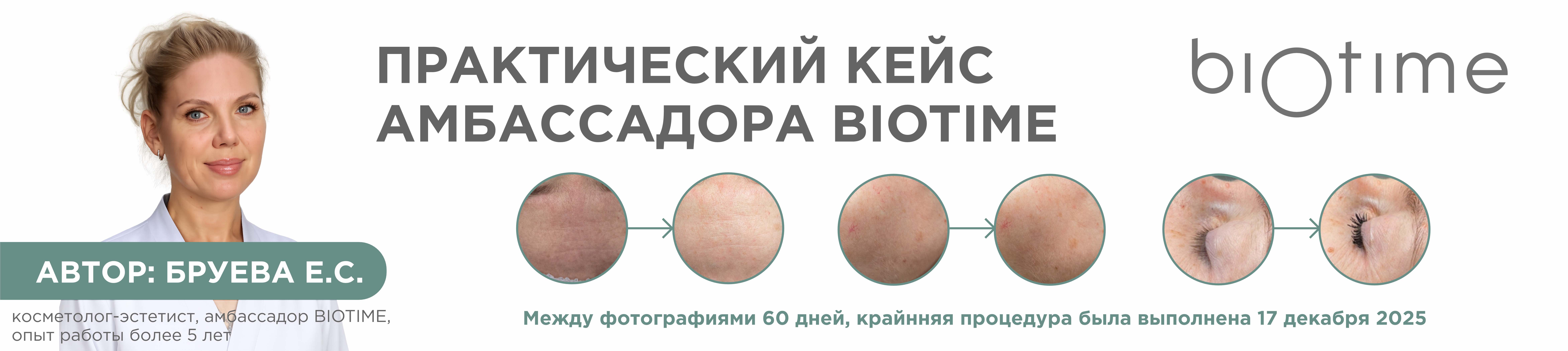 Коррекция проявлений хроностарения кожи в период менопаузы